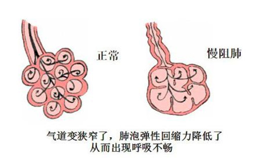 9月起 寶安這十個(gè)社區(qū)40歲以上居民免費(fèi)查慢阻肺