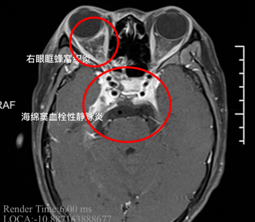 女孩擠痘痘引發(fā)顱內(nèi)感染!醫(yī)生說出真實發(fā)病原因